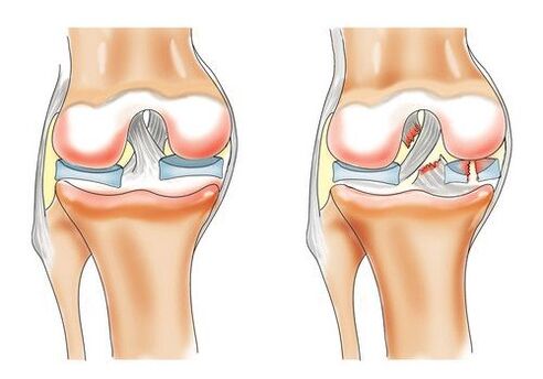 здоровое колено и артроз коленного сустава